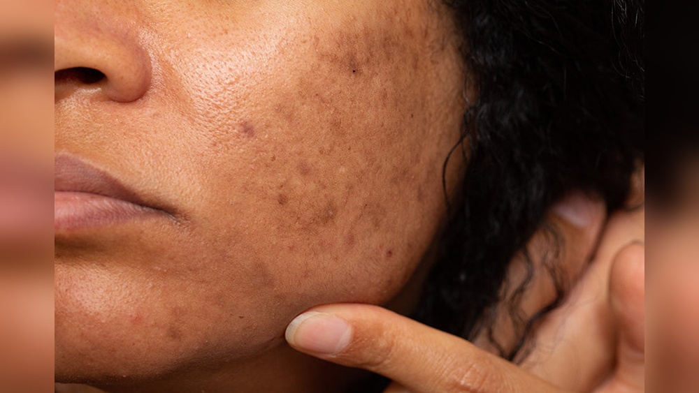Can Vitamin C Serum Cause Dark Spots
