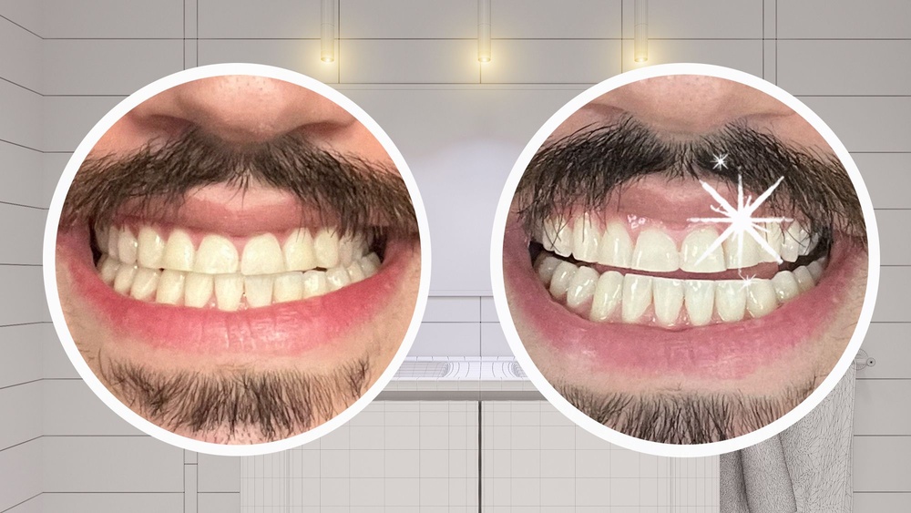 How Long Does It Take for Crest 3D Whitestrips Professional Effects to Work